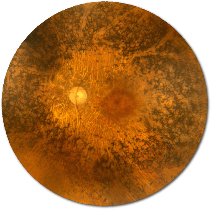 Retinitis Pigmentosa retina